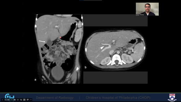 Right upper quadrant pain